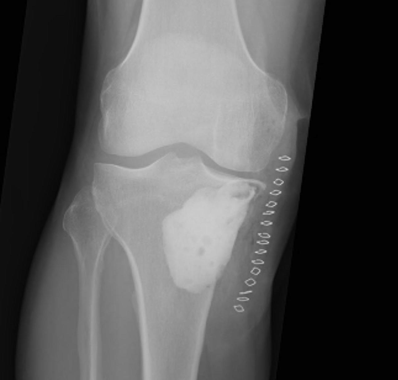 Chondroblastoma Intralesional Currettage and PMMA